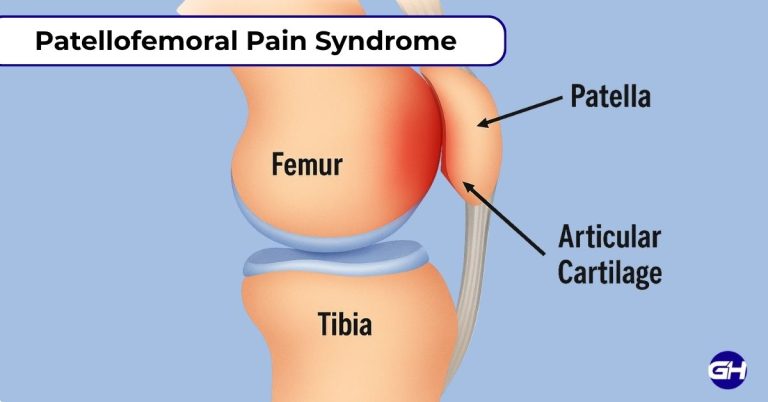 Patellofemoral Pain Syndrome (PFPS)